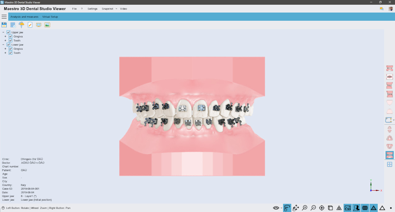 Deltaface, ArchForm, ONYXCEPH, 3Shape Ortho System, 3Shape Clear Aligner Studio, NemoCast, Nemotec, Ortho X Aligner, diorco, dentOne, 3dLeone, 3D Leone Designer, SureSmile Aligner, ulab, ulabsystems, blue sky bio, Maestro 3D, M3D, AGE Solutions, MDS500, Miglior software per ortodontia, Software per posizionamento Brackets, Modelli studio digitali, Prototipazione rapida per odontoiatria, 3D Scanner per gioielleria, Scanner Dentale, Miglior Scanner Dentale, Software ortodontico per allineatori trasparenti, Progettazione digitale di allineatori trasparenti, Software CAD/CAM ortodontico, Prototipazione rapida per ortodonzia, Guida per la produzione di allineatori, Soluzioni software per allineatori dentali, Creazione digitale di apparecchi ortodontici, Modellazione 3D per allineatori dentali, Stampa 3D diretta di allineatori trasparenti, Software per la correzione ortodontica, Tecnologia avanzata per allineatori, Software per la progettazione di espansori, Taglio automatico degli allineatori, Ortho Studio Software, Dental Studio Software, Bande ed Espansori Digitali, Bite-splint digitale, Paradenti digitale, Segmentazione automatica dei denti basata su Intelligenza Artificiale, Ortodonzia digitale basata su Intelligenza Artificiale, Software per il trattamento ortodontico, Software per allineatori dentali con intelligenza artificiale, Allineatori dentali digitali AI, Soluzioni software AI per allineatori dentali, Tecnologia AI per la correzione ortodontica Pianificazione ortodontica basata su intelligenza artificiale, Software per allineatori dentali basato su cloud, Soluzioni cloud per ortodonzia, Web viewer di casi ortodontici